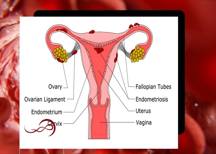 علائم آندومتریوز