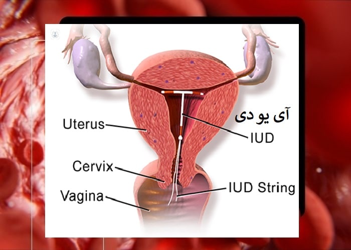 مهم ترین نکات درباره آی یو دی که باید بدانید!!