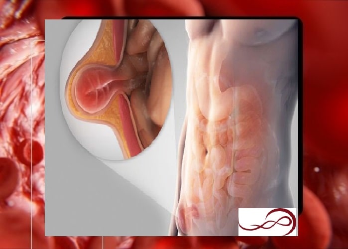 فتق بیضه چیست و به چه علت رخ می‌دهد؟