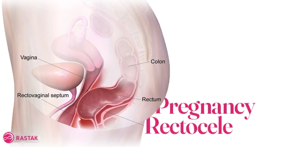رکتوسل چیست
